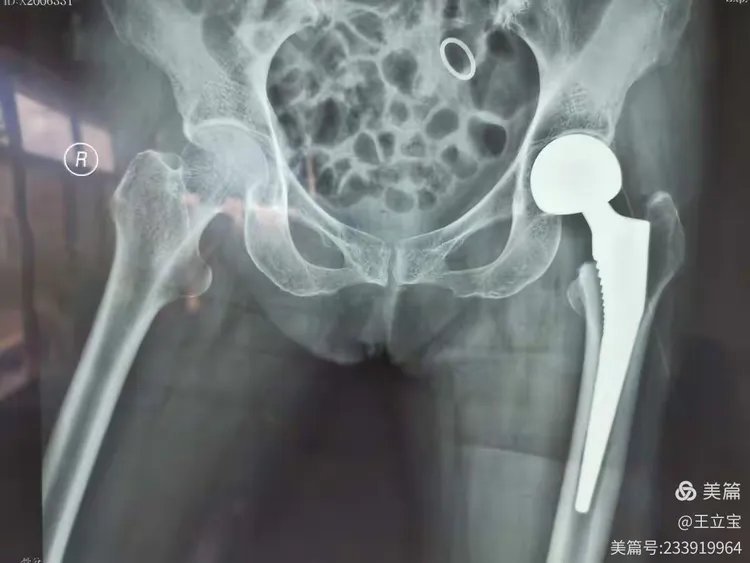 老年股骨颈骨折，人工股骨头置换术